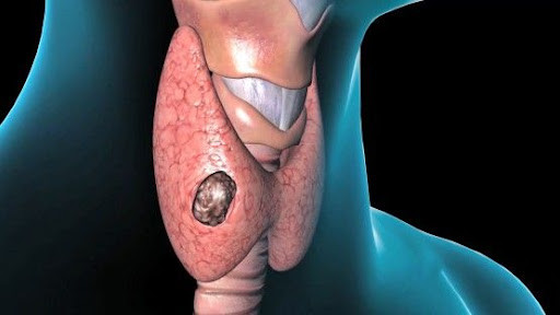 Son illərdə qalxanabənzər vəz xəstəlikləri  niyə artıb?