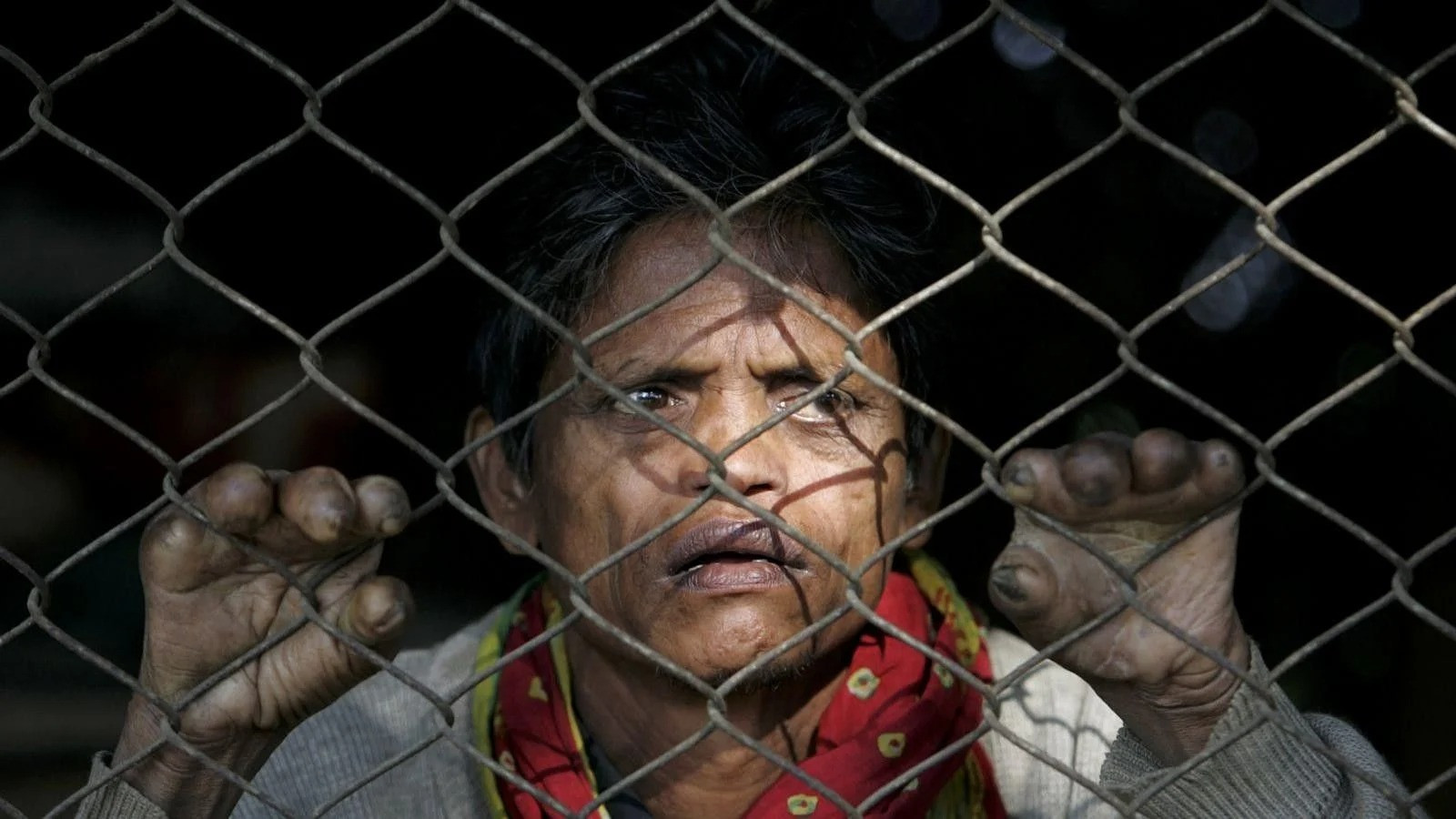 Avropada cüzam xəstəliyi yenidən aşkarlanıb