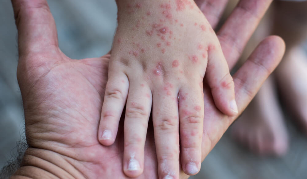 Meymunçiçəyi qayıdır: