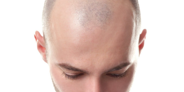 Dünyada ən yüksək keçəllik göstəricisinə malik ölkələr açıqlanıb