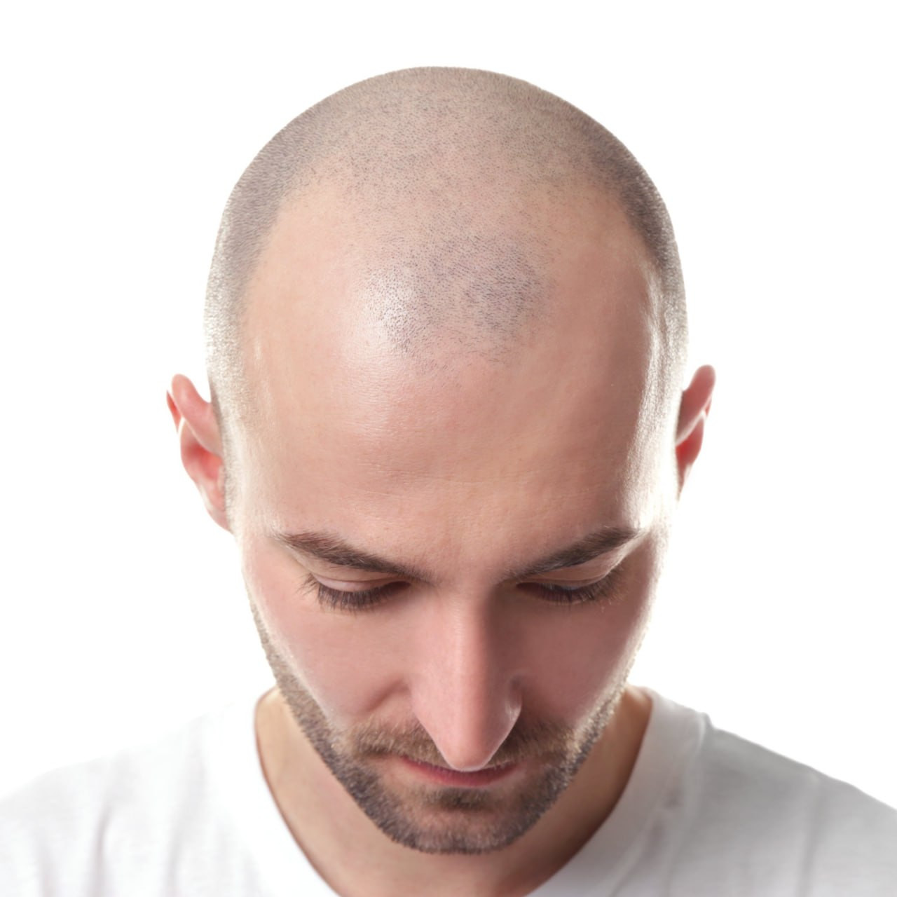 Dünyada ən yüksək keçəllik göstəricisinə malik ölkələr açıqlanıb