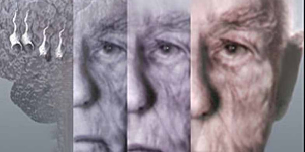 Alzheimer xəstəliyi getdikcə daha gənc yaşlarda görünür –