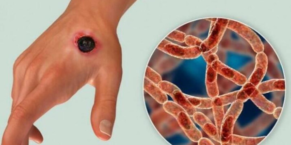 Qarayara xəstəliyi ilə bağlı tədbir görülürmü? -
