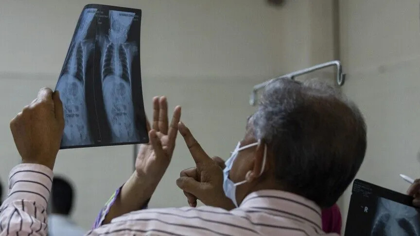 Banqladeşdə qızılca epidemiyası 1030 nəfərin ölümünə səbəb olub