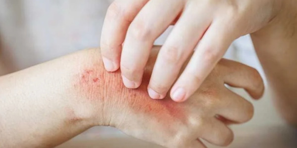 Allergiya istənilən yaşda yarana bilər: alimlər yeni səbəbləri araşdırır