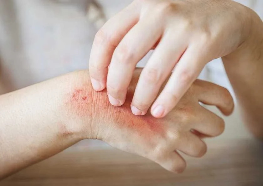 Allergiya istənilən yaşda yarana bilər: alimlər yeni səbəbləri araşdırır