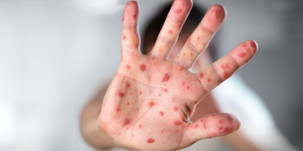Qızılca epidemiyası ABŞ-də ölümə səbəb oldu