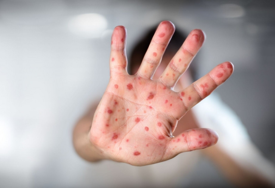 Qızılca epidemiyası ABŞ-də ölümə səbəb oldu