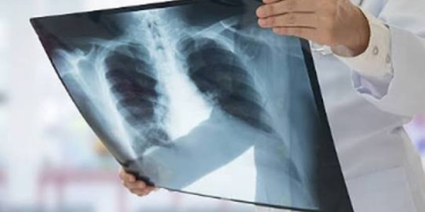 COVID-19-dan sağalan şəxsin ağciyərində 35 ay sonra virus izləri tapılıb