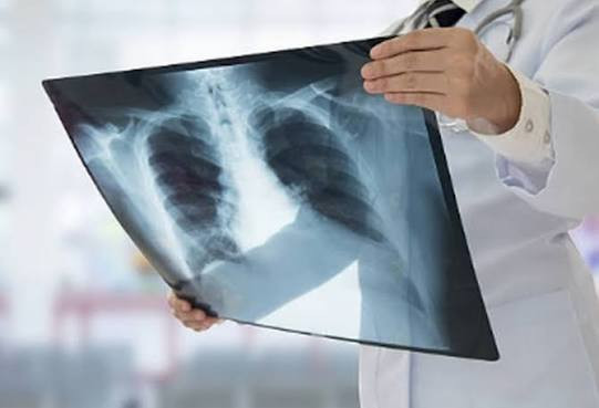 COVID-19-dan sağalan şəxsin ağciyərində 35 ay sonra virus izləri tapılıb